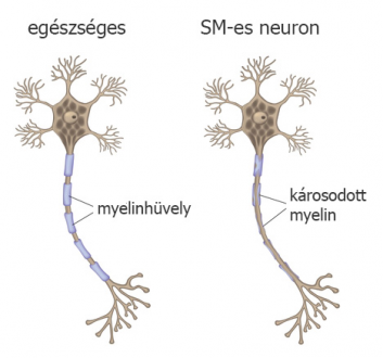 myelin_sclerosis_multiplex