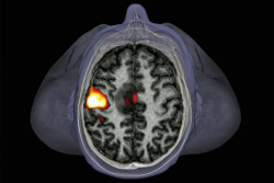 c0211947-brain_tumour_fmri_scan-spl